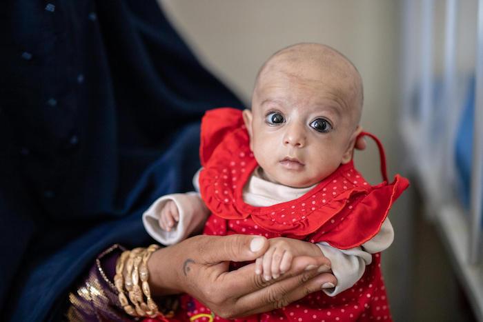 5-month-old Sabera is cradled in the arms of her mother. She is suffering from severe acute malnutrition
