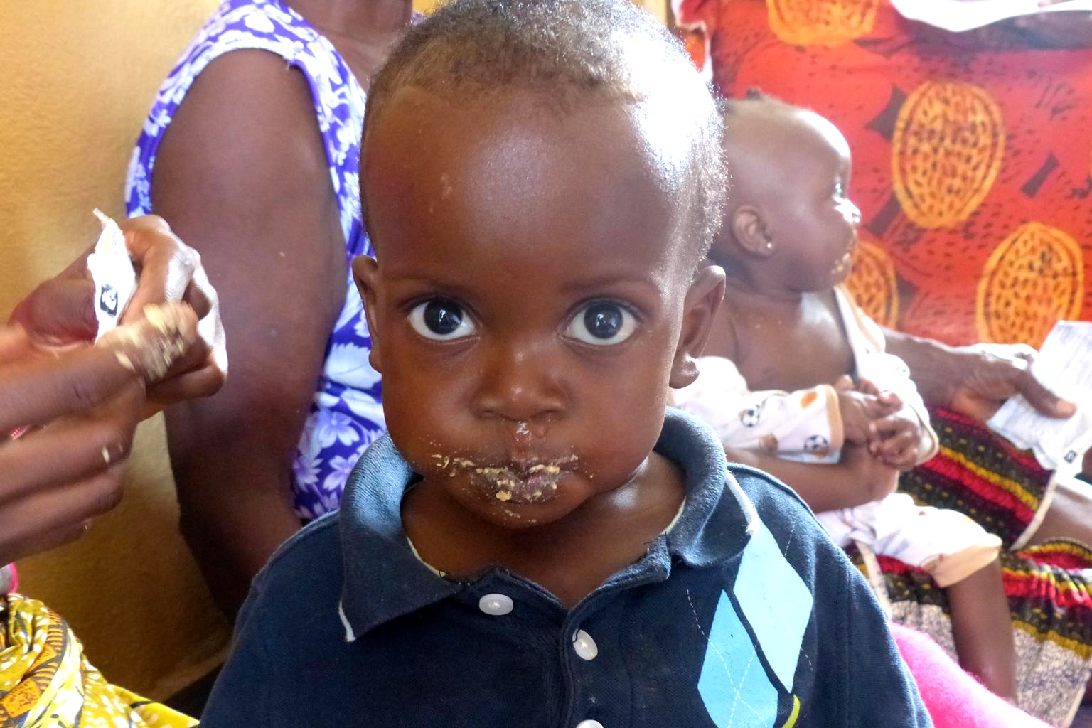 A malnourished boy in Liberia get ready-to-use therapeutic food.