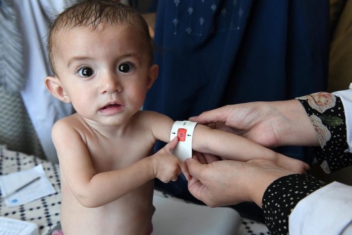 Fatima, 10 months old, is screened by doctors and diagnosed with severe acute malnutrition, in the hospital of the Kishim district in the North of Afghanistan.