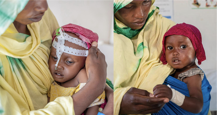 From critical condition to stable: 1-year-old Aisha, cradled in her mother's arms, upon arriving at a stabilization center in Puntland Somalia for treatment for severe acute malnutrition (left) and three days after the start of treatment (right).