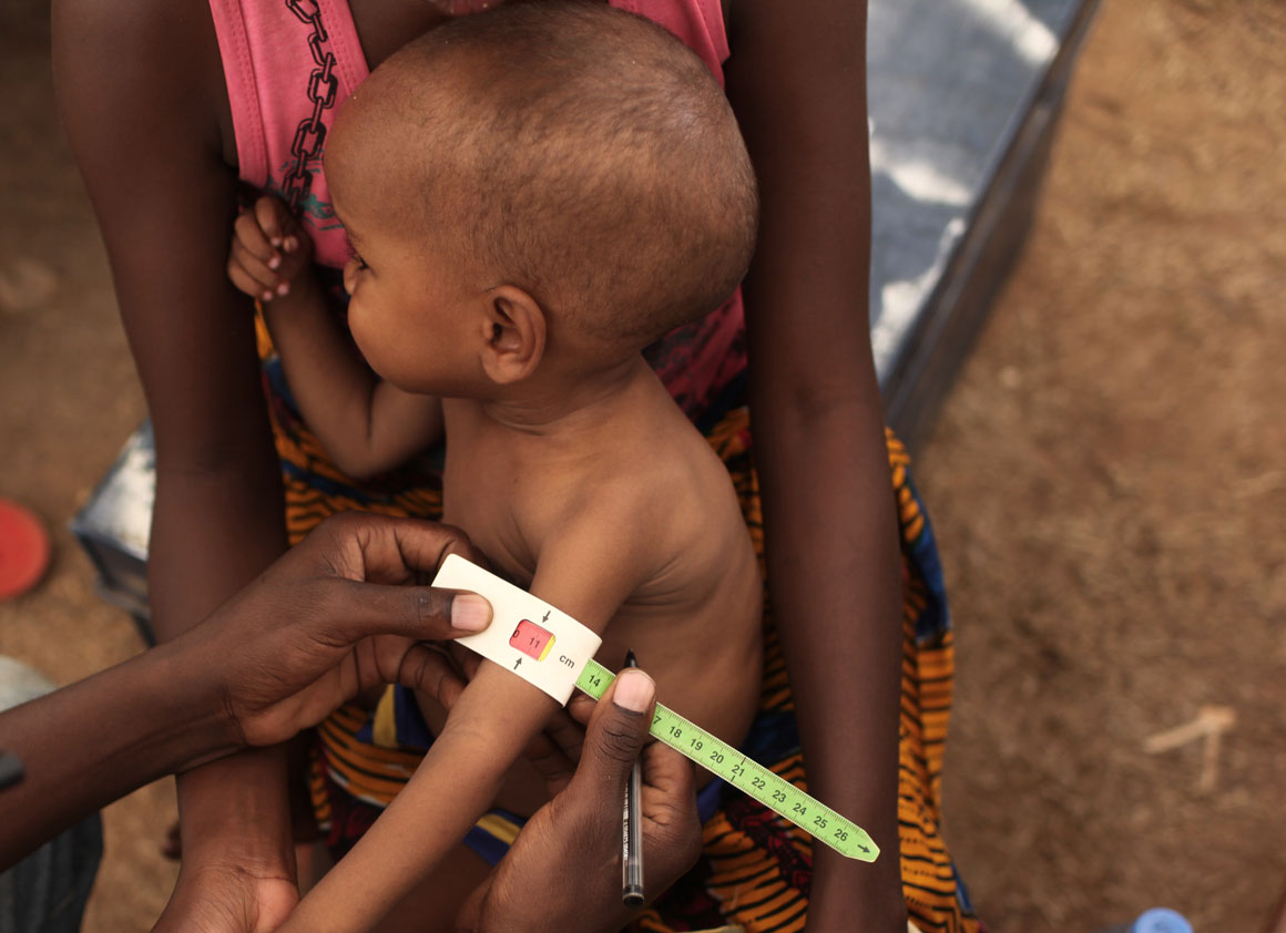 Tony, 24 months old, is screened for malnutrition, at a mobile clinic in Bangui, the capital. He weighs just 7 kg and is also suffering from respiratory complications. The red section on the mid-upper arm circumference band being used to assess his nutrit