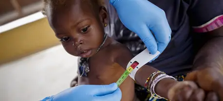 Mariama Lansanna, who is 35 years old, holds her baby Hawa, who is showing signs of malnutrition, while her middle upper arm circumference is measured at the health centre in Juru, near Kenema in Sierra Leone 