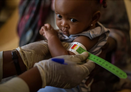 A child is screened for severe acute malnutrition in Sudan.