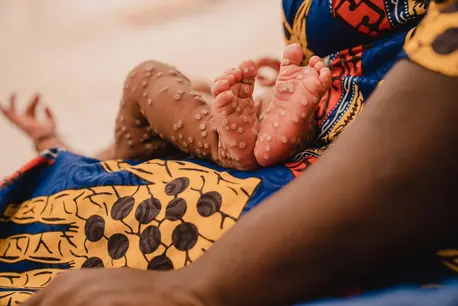 The legs and feet of a 1-month-old baby with mpox lying in her mother's lap at the UNICEF-supported Kamanyola Hospital in South Kivu province, Democratic Republic of the Congo (DRC), on July 24, 2024.