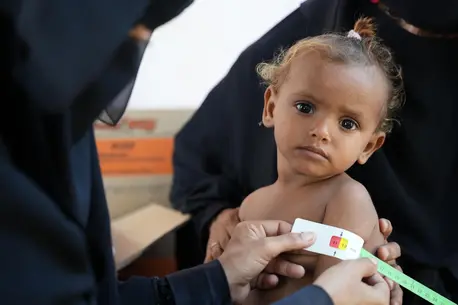 A child's upper arm is measured for signs of malnutrition