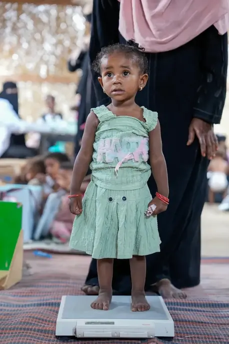 Rana of Yemen at 18 months, on her way to a full recovery from severe acute malnutrition with UNICEF support.