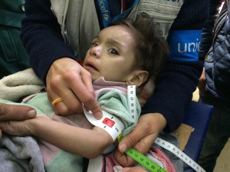 #SyriaCrisis End the Suffering On 14 January 2016, a child is screened for malnutrition at a make-shift hospital in Madaya. The UNICEF team and staff of the World Health Organisation were able to screen 25 children under five for malnutrition.