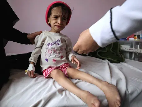 Conflict in Yemen has exposed 320,000 children to severe actue malnutrition (SAM), among them Hanadi who will be 3 in four months but can't walk. UNICEF aims to treat over 170,000 children for SAM in 2016. Conflict in Yemen has exposed 320,000 children to severe actue malnutrition (SAM), among them Hanadi who will be 3 in four months but can't walk. UNICEF aims to treat over 170,000 children for SAM in 2016.
