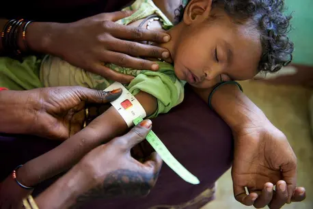 A health worker checks 9-month-old Zainab for malnutrition at a UNICEF-supported nutrition center in Kasala, Sudan. Sudan, Unicef, malnourished children, fight hunger, unicef usa