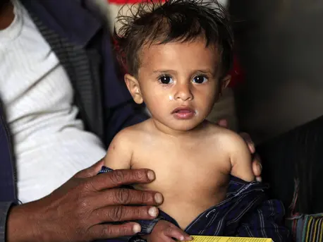 UNICEF and partners treated Yemeni baby Yahya Hamoud Ali, 9 months, for malnutrition in Sana'a in October 2018. UNICEF and partners treated Yemeni baby Yahya Hamoud Ali, 9 months, for malnutrition in Sana'a in October 2018.