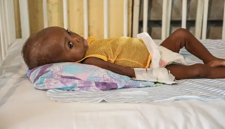 One of many children being treated for acute malnutrition at the UNICEF-supported pediatric unit of the Hospital Immaculee Conception in Les Cayes, Haiti. One of many children being treated for acute malnutrition at the UNICEF-supported pediatric unit of the Hospital Immaculee Conception in Les Cayes, Haiti.