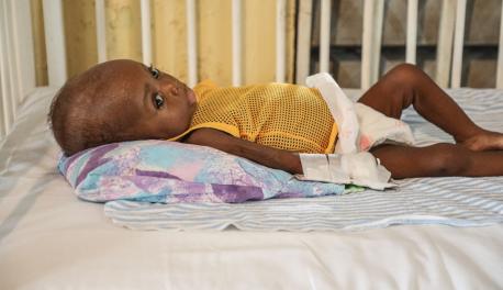 One of many children being treated for acute malnutrition at the UNICEF-supported pediatric unit of the Hospital Immaculee Conception in Les Cayes, Haiti.