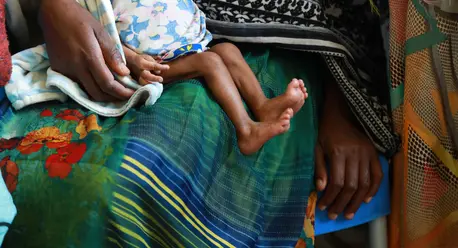 Severely malnourished baby receives care at a UNICEF-supported stabilization unit in Ayder hospital in Mekelle, Tigray region, Ethiopia. Severely malnourished baby receives care at a UNICEF-supported stabilization unit in Ayder hospital in Mekelle, Tigray region, Ethiopia.