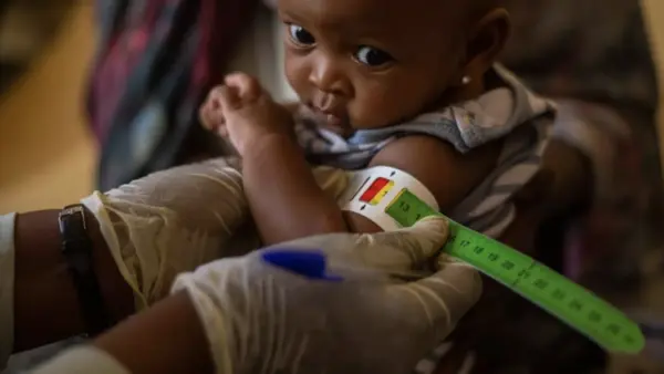 A child is screened for severe acute malnutrition in Sudan.