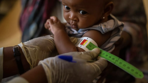 A child is screened for severe acute malnutrition in Sudan.