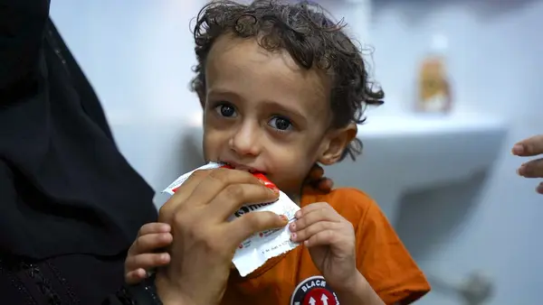 At Al-maidan Health Center in Aden, Yemen, 3-year-old Ali eats from a packet of Ready-to-Use Therapeutic Food supplied by UNICEF.