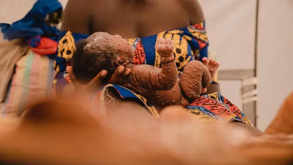 A mother holds her 1-month-old baby daughter at the mpox isolation unit of the UNICEF-supported Kamanyola Hospital in South Kivu province, Democratic Republic of the Congo, on July 24, 2024.