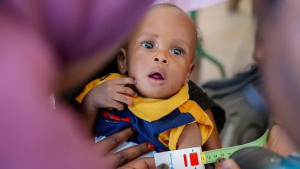A child is screened for malnutrition at Beet Elshabab internally displaced people's (IDP) camp in Port Sudan on Oct. 22, 2024. 