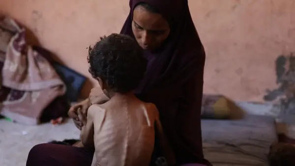 A severely malnourished boy sits on his mother's lap in the Gaza Strip on July 28, 2025.