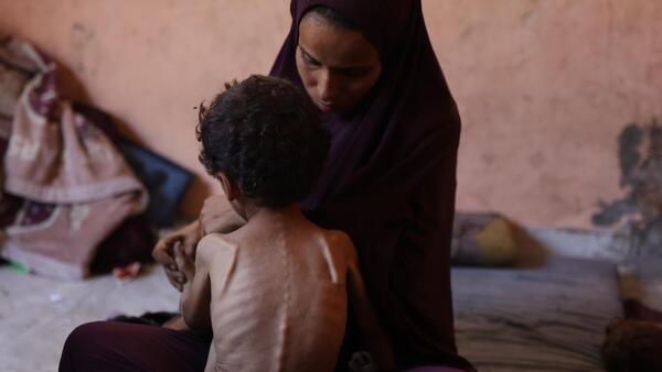 A severely malnourished boy sits on his mother's lap in the Gaza Strip on July 28, 2025.