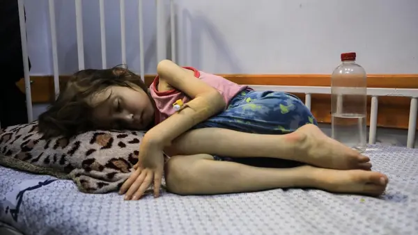A child suffering from malnutrition lies on a bed at UNICEF-supported Patient Society Hospital in Gaza City on July 29, 2025. 