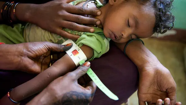 Sudan, Unicef, malnourished children, fight hunger, unicef usa