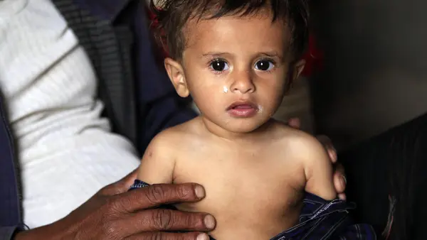 UNICEF and partners treated Yemeni baby Yahya Hamoud Ali, 9 months, for malnutrition in Sana'a in October 2018.