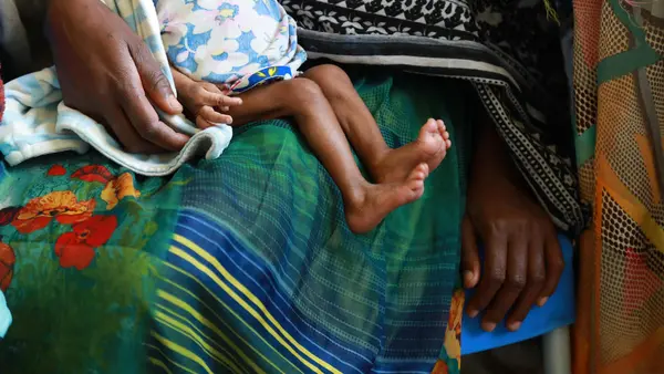 Severely malnourished baby receives care at a UNICEF-supported stabilization unit in Ayder hospital in Mekelle, Tigray region, Ethiopia.