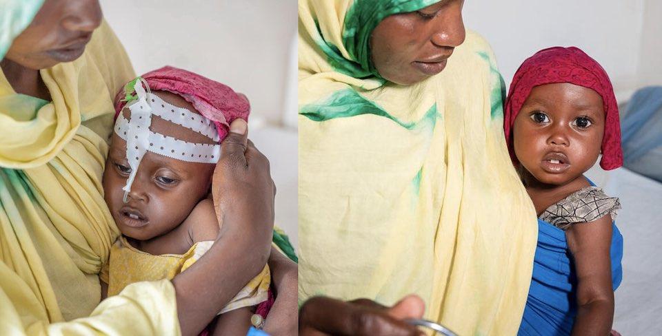 Aisha, upon arrival at a UNICEF-supported treatment center in Garowe, Puntland, Somalia, and Aisha, three days later, on the road to recovery from severe acute malnutrition..