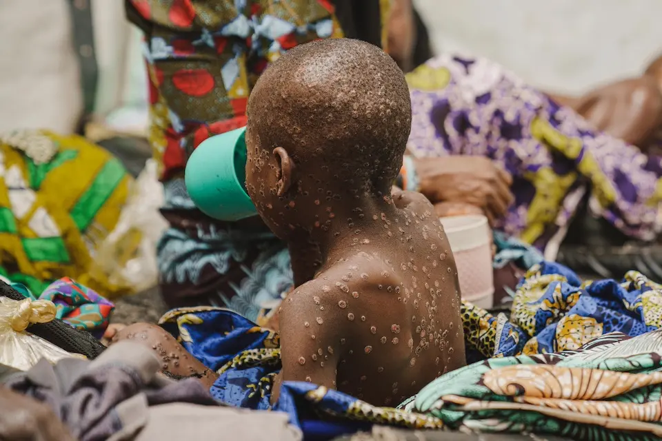 A child suffering from mpox at the mpox isolation unit of the UNICEF-supported Kavumu Hospital in South Kivu province, DR Congo, on 23 July 2024.