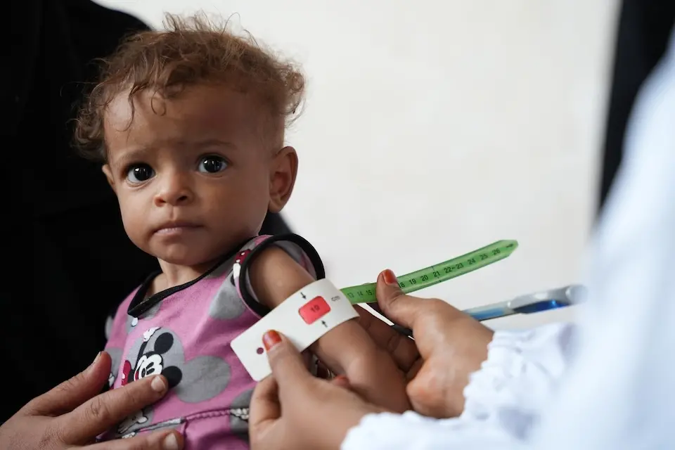 In Al-Kawkhah, Al-Hudaidah, Yemen, a health worker uses a MUAC tape to measure a child’s mid-upper arm circumference; the reading shows that the child is suffering from severe acute malnutrition and requires immediate treatment.