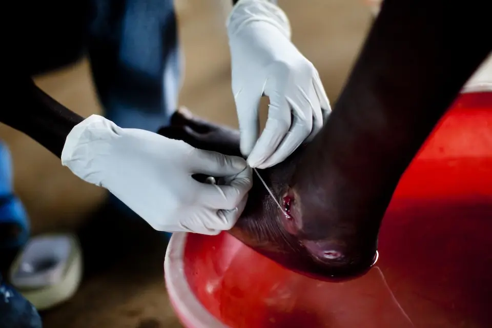 In Sudan in 2012, a Guinea worm is extracted from a patient’s foot by wrapping it around a stick and carefully pulling it out.