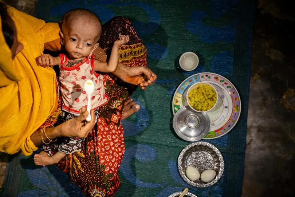 A 14-month-old child exhibits symptoms of wasting at a refugee camp in Bangladesh. © UNICEF / Ilvy Njiokiktjien / UNI622135