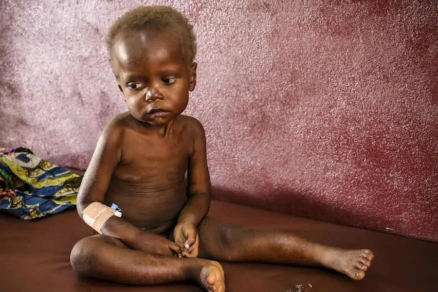 Using Ready-to-Use Therapuetic Food, UNICEF aims to reach nearly 40,000 children in the Central African Republic with lifesaving nutrition. Using Ready-to-Use Therapuetic Food, UNICEF aims to reach nearly 40,000 children in the Central African Republic with lifesaving nutrition.