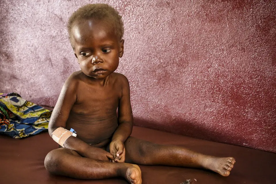 On 20 July 2018 in the Central African Republic, Pierre Mbassissi in bed at the malnutrition stabilisation centre at the Bangui Paediatric hospital. On 20 July 2018 in the Central African Republic, Pierre Mbassissi in bed at the malnutrition stabilisation centre at the Bangui Paediatric hospital.