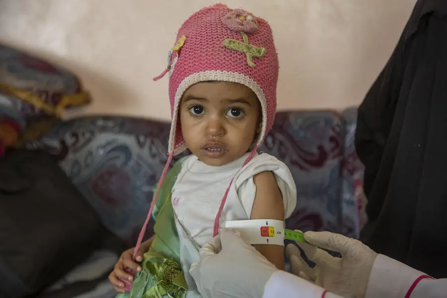 A UNICEF-supported community health worker checks a baby's mid-upper arm circumference to see if she is malnourished in Yemen's Hajjah Governate in March 2019. A UNICEF-supported community health worker checks a baby's mid-upper arm circumference to see if she is malnourished in Yemen's Hajjah Governate in March 2019.