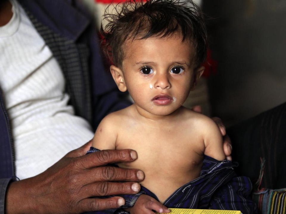 UNICEF and partners treated Yemeni baby Yahya Hamoud Ali, 9 months, for malnutrition in Sana'a in October 2018.