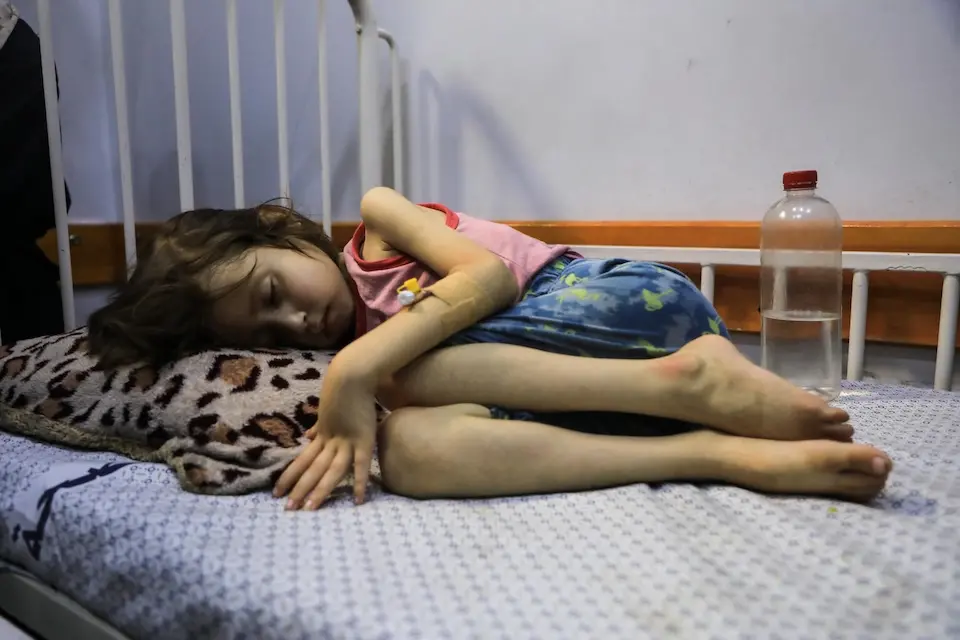 A child suffering from malnutrition lies on a bed at UNICEF-supported Patient Society Hospital in Gaza City on July 29, 2025. 