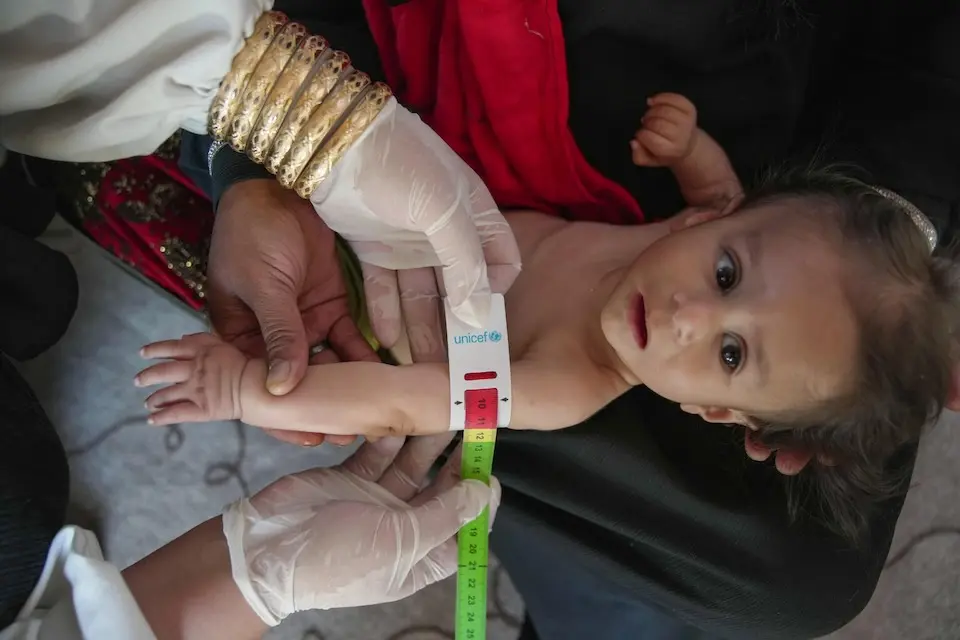 Eight-month-old Bahram is diagnosed with severe acute malnutrition t a UNICEF-supported day-care in Kabul, Afghanistan. (© UNICEF / Azizullah Karimi / UNI885829)