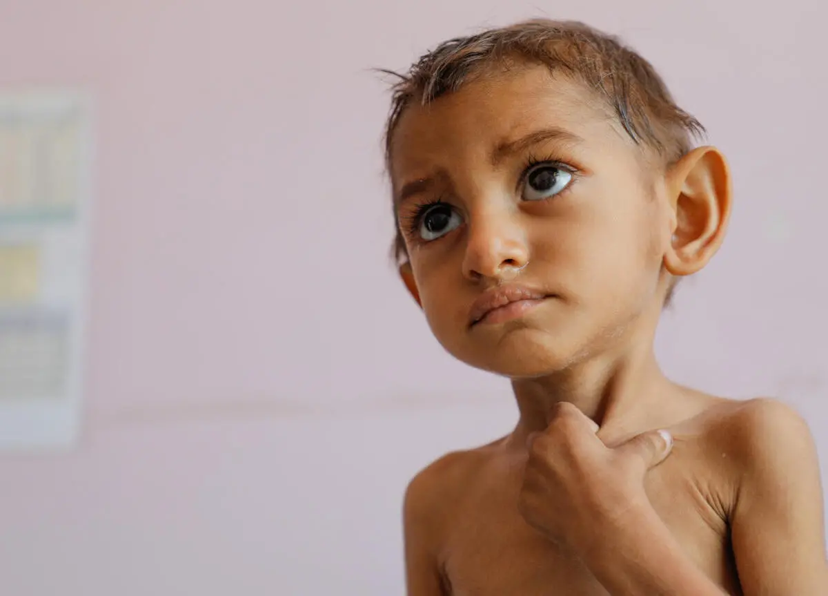 In 2021, 2-year-old Aseel's mother and uncle brought him to the UNICEF-supported therapeutic feeding center at Al-Sabeen Hospital in Sana'a City, Yemen for treatment. In 2021, 2-year-old Aseel's mother and uncle brought him to the UNICEF-supported therapeutic feeding center at Al-Sabeen Hospital in Sana'a City, Yemen for treatment.