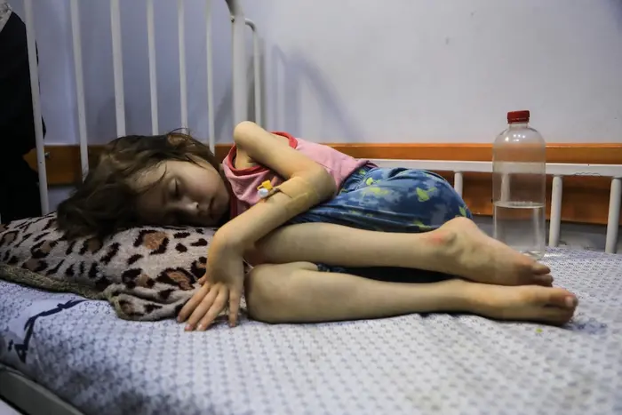 A child suffering from malnutrition lies on a bed at UNICEF-supported Patient Society Hospital in Gaza City on July 29, 2025. 