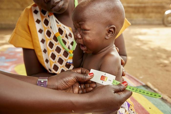 Eight-month-old Akot's mid-upper arm circumference measurement helped confirm he was suffering from severe acute malnutrition in Aweil, South Sudan, May 2019.