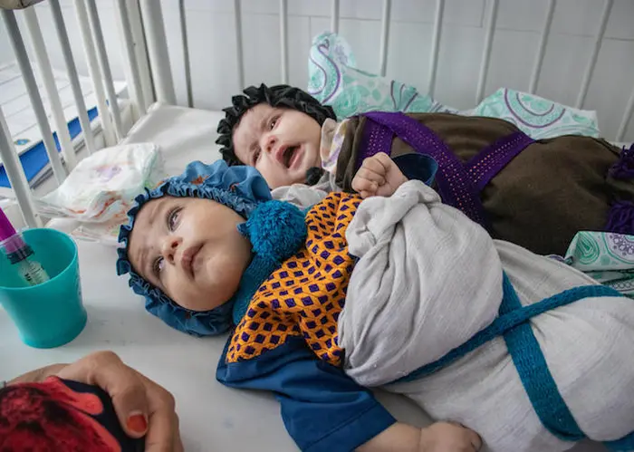 In Afghanistan on September 28, 2021, 4-month old twins Aisha and Youssef are being provided with medical care and therapeutic food at the UNICEF-supported Inpatient Therapeutic Feeding Center in Herat Regional Hospital.