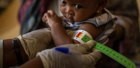 A child is screened for severe acute malnutrition in Sudan.